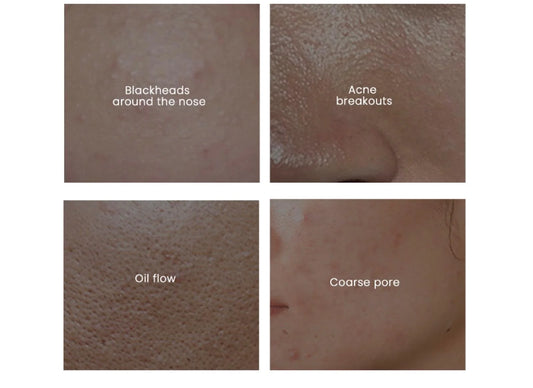 Blackheads around the nose